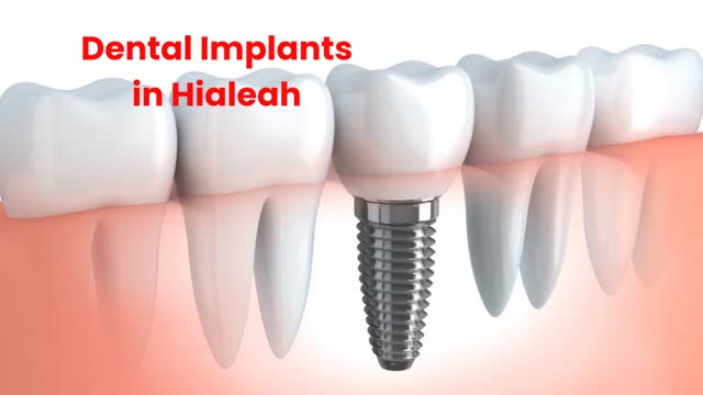 Rielo Dental Clinic : #1 Dental Implants in Hialeah, FL | 305-231-5455