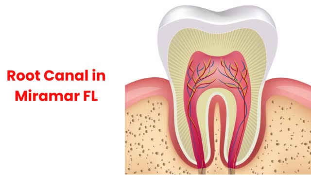 Veneto Dental Care _ #1 Root Canal in Miramar, FL _ 33025