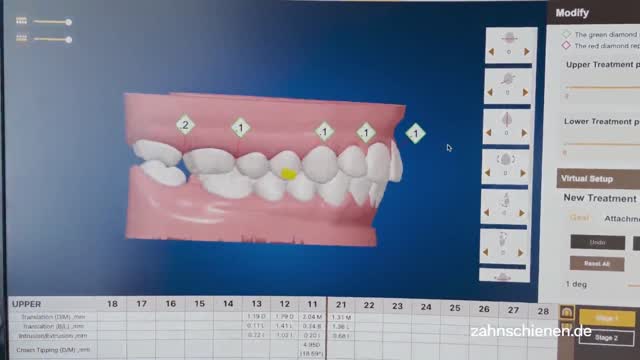 Unsichtbare Zahnspange