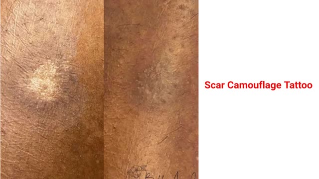 Belle Ame Skin And Beauty - Expert Scar Camouflage Tattoo Service in Burnaby, BC