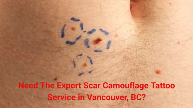 Belle Ame Skin And Beauty - Expert Scar Camouflage Tattoo Service in Vancouver, BC