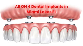 Miami Lakes Dental Health Center : All ON 4 Dental Implants in Miami Lakes, FL