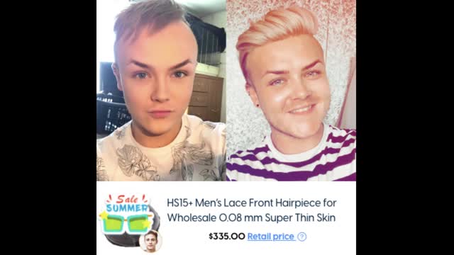 6 Hair Loss Sufferers Tell you how much does hair replacement cost