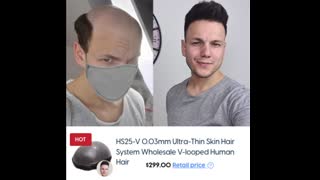 6 Hair Loss Sufferers Tell you how much does hair replacement cost
