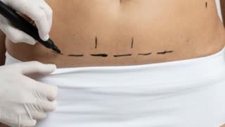Surface 360 Cosmetic Surgery and Med Spa - Quilting Abdominoplasty in Southlake, TX