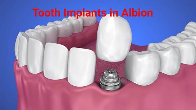 Albion Family Dental - Permanent Solutions With Tooth Implants in Albion, NY