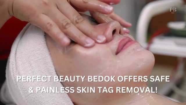 Affordable Skin Tag Removal in Singapore  Perfect Beauty